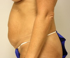 Tummy Tuck Before and After Pictures Birmingham, AL