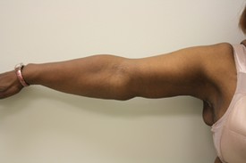 Brachioplasty Before and After Pictures Birmingham, AL