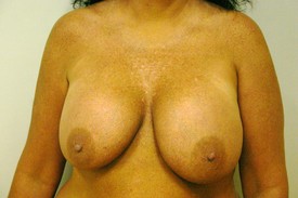 Breast Lift Before and After Pictures Birmingham, AL