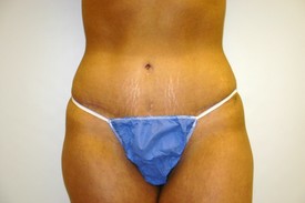 Tummy Tuck Before and After Pictures Birmingham, AL