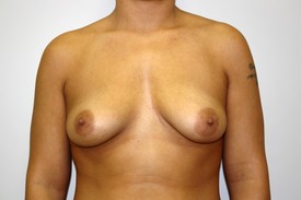 Breast Augmentation Before and After Pictures Birmingham, AL