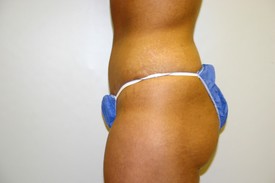 Tummy Tuck Before and After Pictures Birmingham, AL