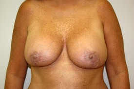 Breast Lift Before and After Pictures Birmingham, AL