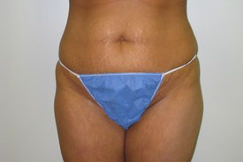 Tummy Tuck Before and After Pictures Birmingham, AL