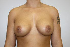 Breast Augmentation Before and After Pictures Birmingham, AL