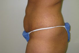 Tummy Tuck Before and After Pictures Birmingham, AL