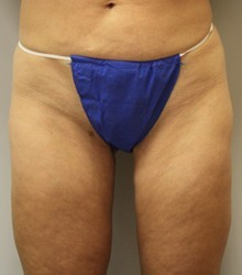 Laser Lipo with SlimLipo Before and After Pictures Birmingham, AL