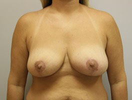 Breast Reduction Before and After Pictures Birmingham, AL