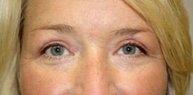 Blepharoplasty Before and After Pictures Birmingham, AL