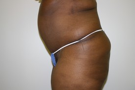 Tummy Tuck Before and After Pictures Birmingham, AL