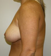 Breast Reduction Before and After Pictures Birmingham, AL