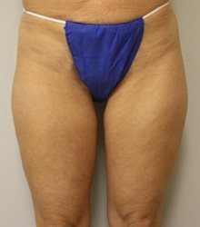 Laser Lipo with SlimLipo Before and After Pictures Birmingham, AL