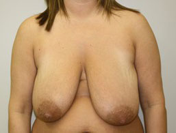 Breast Reduction Before and After Pictures Birmingham, AL