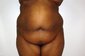 Tummy Tuck Before and After Pictures Birmingham, AL