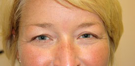 Blepharoplasty Before and After Pictures Birmingham, AL