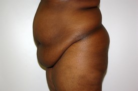 Tummy Tuck Before and After Pictures Birmingham, AL