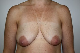 Breast Lift Before and After Pictures Birmingham, AL