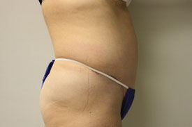 Tummy Tuck Before and After Pictures Birmingham, AL