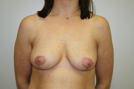 Breast Lift Before and After Pictures Birmingham, AL