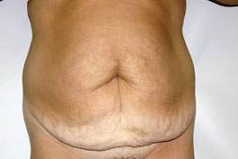 Tummy Tuck Before and After Pictures Birmingham, AL