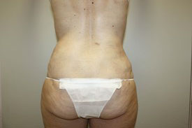 Laser Lipo with SlimLipo Before and After Pictures Birmingham, AL