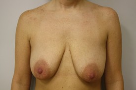 Breast Lift Before and After Pictures Birmingham, AL