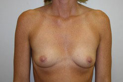 Breast Augmentation Before and After Pictures Birmingham, AL