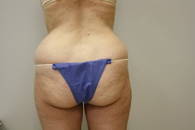 Laser Lipo with SlimLipo Before and After Pictures Birmingham, AL