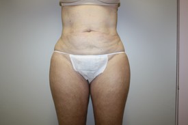 Laser Lipo with SlimLipo Before and After Pictures Birmingham, AL