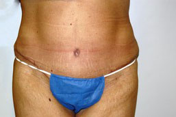 Tummy Tuck Before and After Pictures Birmingham, AL