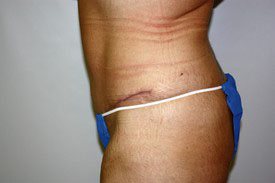 Tummy Tuck Before and After Pictures Birmingham, AL