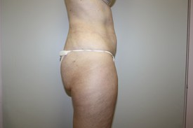 Laser Lipo with SlimLipo Before and After Pictures Birmingham, AL