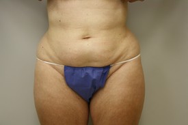 Laser Lipo with SlimLipo Before and After Pictures Birmingham, AL