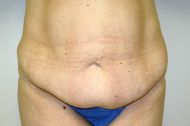 Tummy Tuck Before and After Pictures Birmingham, AL