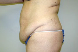 Tummy Tuck Before and After Pictures Birmingham, AL