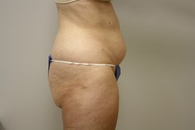 Laser Lipo with SlimLipo Before and After Pictures Birmingham, AL