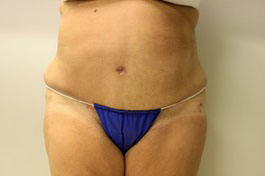 Tummy Tuck Before and After Pictures Birmingham, AL