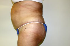 Tummy Tuck Before and After Pictures Birmingham, AL