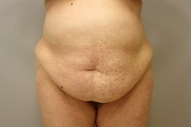 Tummy Tuck Before and After Pictures Birmingham, AL