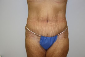 Tummy Tuck Before and After Pictures Birmingham, AL