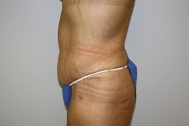 Tummy Tuck Before and After Pictures Birmingham, AL