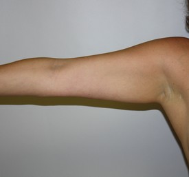 Laser Lipo with SlimLipo Before and After Pictures Birmingham, AL
