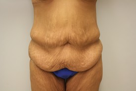 Tummy Tuck Before and After Pictures Birmingham, AL