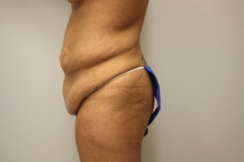 Tummy Tuck Before and After Pictures Birmingham, AL