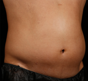 SculpSure® Before and After Pictures Birmingham, AL