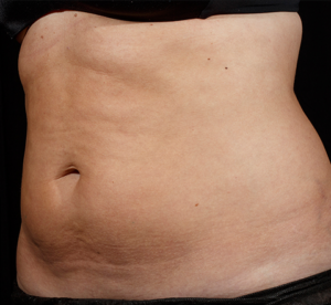SculpSure® Before and After Pictures Birmingham, AL