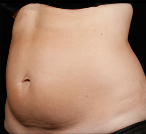 SculpSure® Before and After Pictures Birmingham, AL